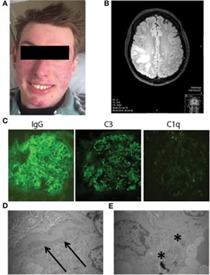 C1q Deficiency and <mark class="highlighted">Neuropsychiatric Systemic Lupus Erythematosus</mark>